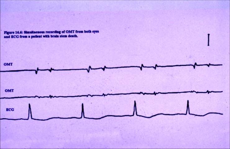 Brainstem Death